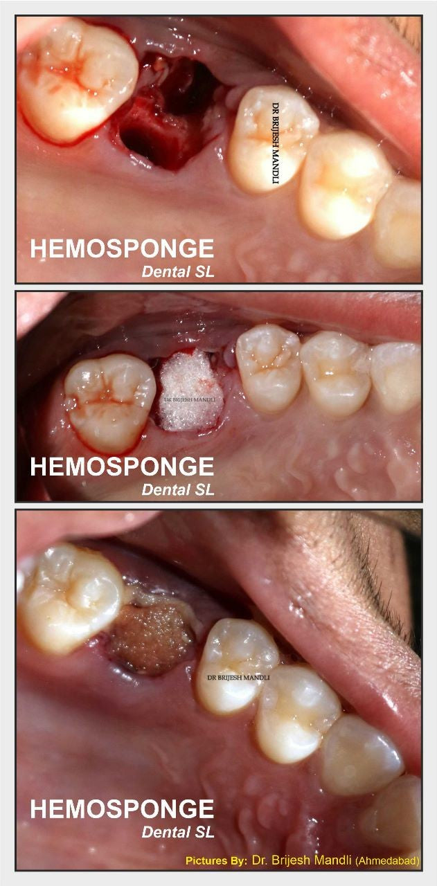 Hemosponge dental SL 10x10x10mm